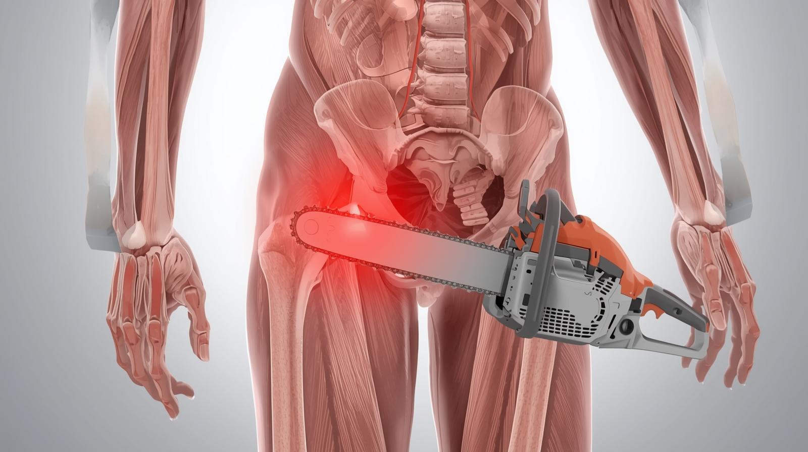 Chainsaw Injuries and Limb Amputations